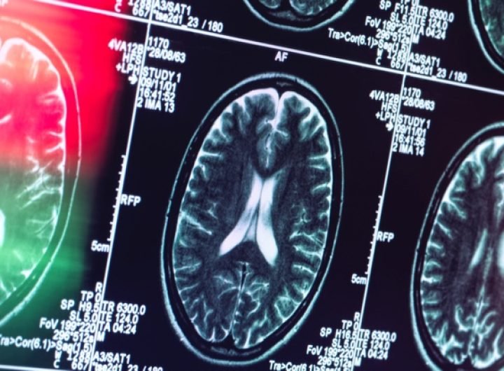 Alzheimer's May Not Actually Be a Brain Disease, an Expert Reveals : ScienceAlert