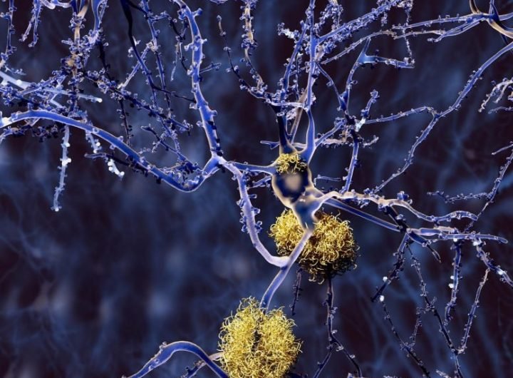 Alzheimer Disease Neurons With Amyloid Plaques