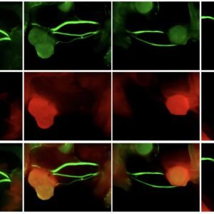 Fluorescence-guided imaging technique could improve head and neck cancer surgery