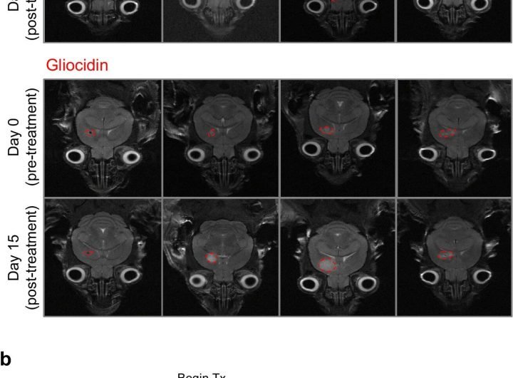 Glioblastoma treatment shows promise in mouse study