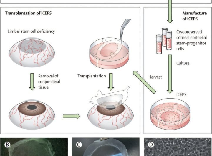 Human vision restored by stem cell replacement in regenerative medicine breakthrough