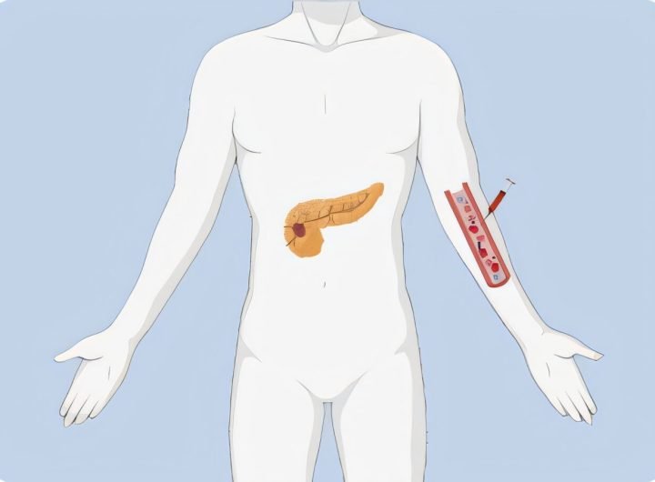 Liquid biopsy shows potential for pancreatic incidentaloma detection