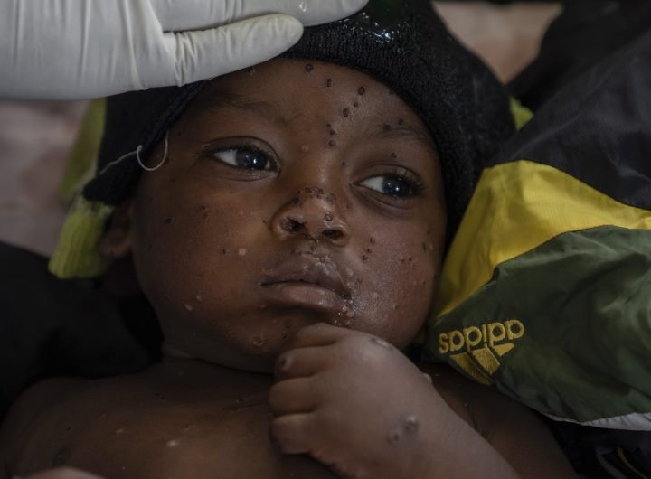 Mpox cases in Congo may be stabilizing. Experts say more vaccines are needed to stamp out virus