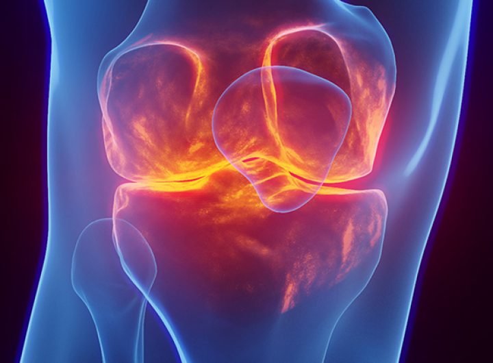 Ozempic Gives Strong Relief to Severe Knee Pain, Clinical Trial Suggests : ScienceAlert