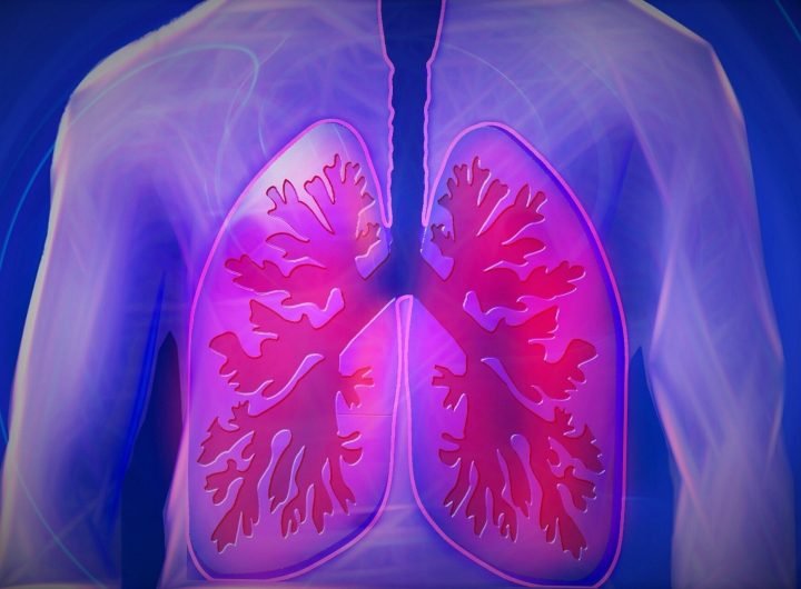 Physician offers tips for living with chronic obstructive pulmonary disease