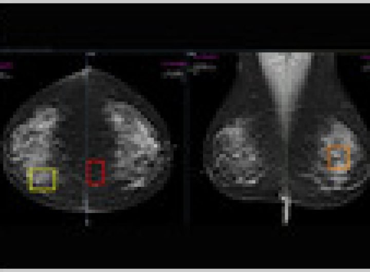 A study involving 747,604 women finds those who paid extra for AI-enhanced mammograms were 21% more likely to have breast cancer detected than those who didn't (Margherita Bassi/Gizmodo)