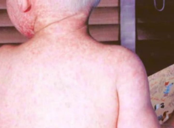 AHS issues public alert after measles case confirmed in Calgary