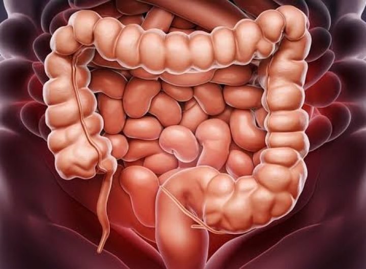 Colorectal cancer