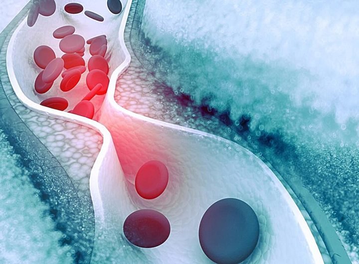 Coronary artery disease common in patients with cirrhosis