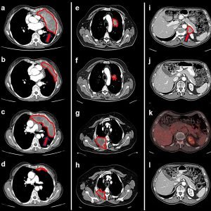 GDF-15 inhibitors show promise against hard-to-treat tumors in clinical trial