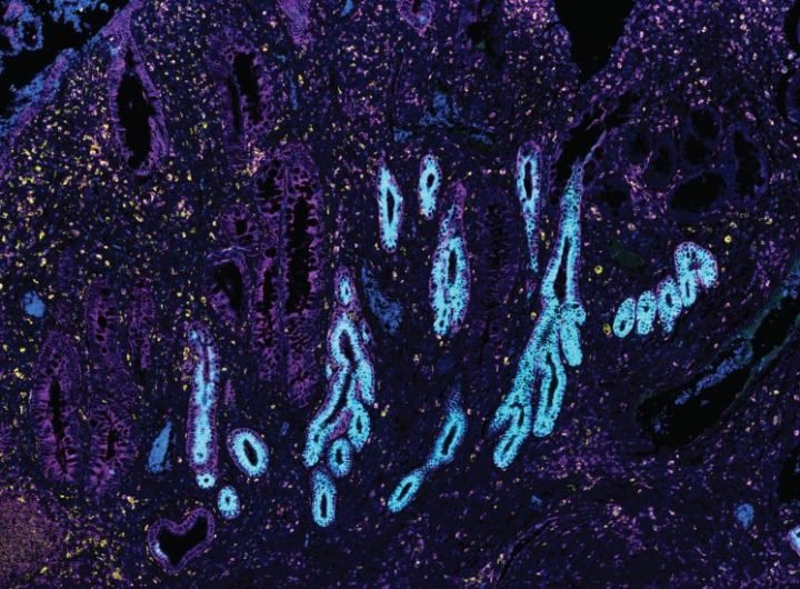 Human Intestinal Tract in IBD