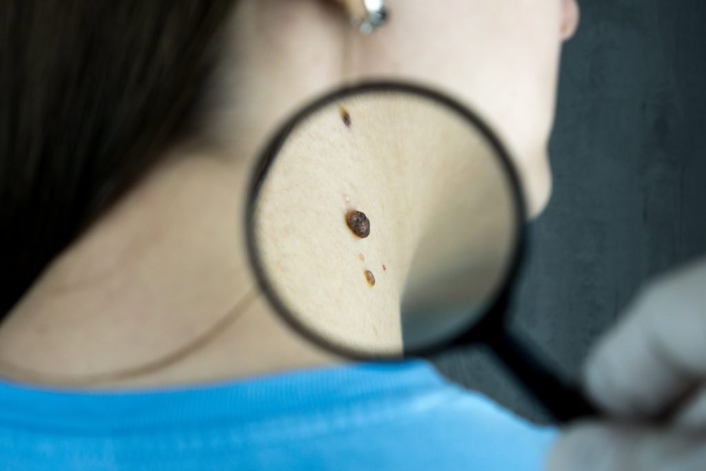 Melanoma survival linked to tumor thickness