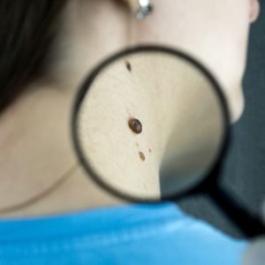 Melanoma survival linked to tumor thickness