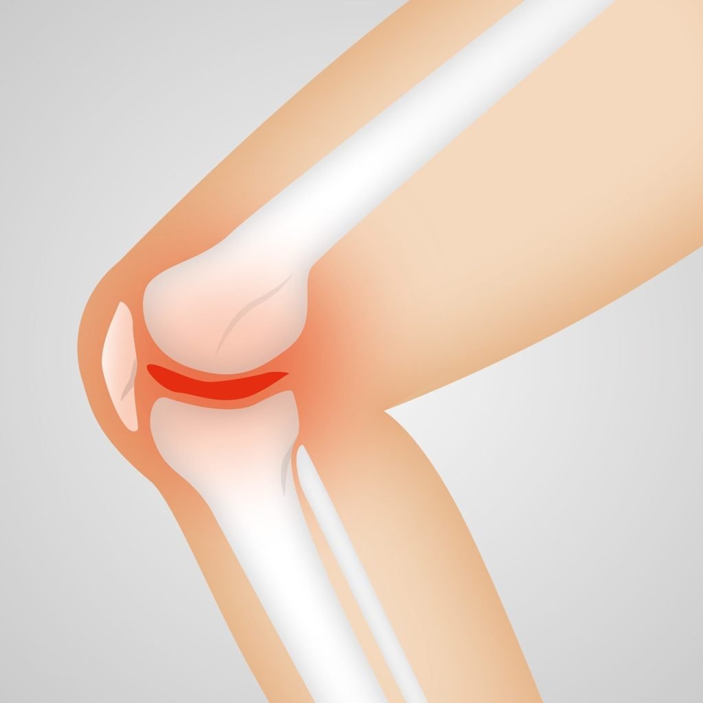 Researchers develop new test for early osteoarthritis diagnosis