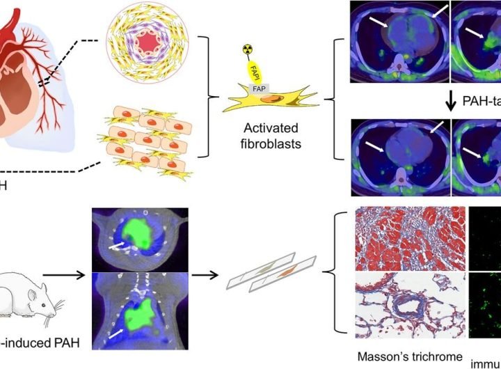 Novel PET approach identifies early signs of pulmonary arterial hypertension