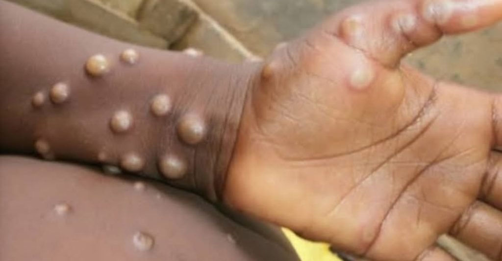 Residents of Baguio are urged to stay alert after the first case of monkeypox, or mpox, was reported in the city, according to health authorities.