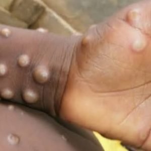 Residents of Baguio are urged to stay alert after the first case of monkeypox, or mpox, was reported in the city, according to health authorities.