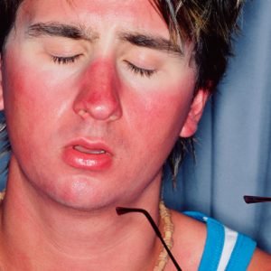 We've Been Wrong About What Causes Sunburn, Scientists Discover : ScienceAlert