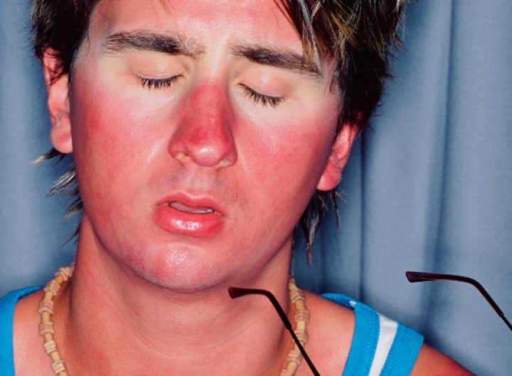 We've Been Wrong About What Causes Sunburn, Scientists Discover : ScienceAlert